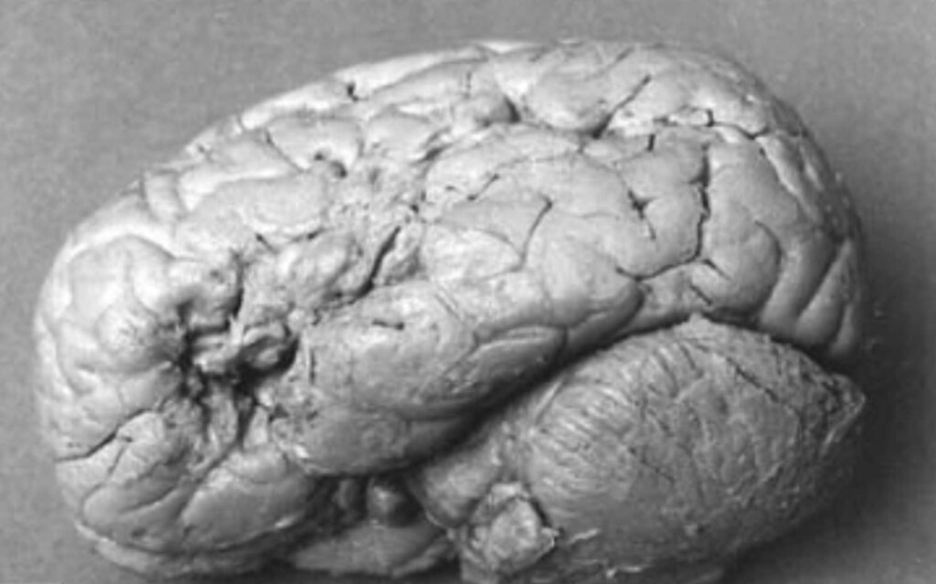 cervello paziente tan tan