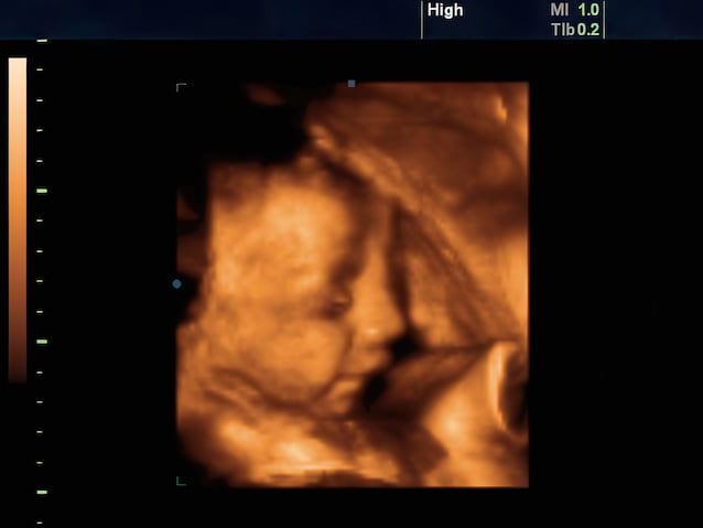 4D ultrasound