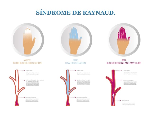 Raynaud phenomenon phases