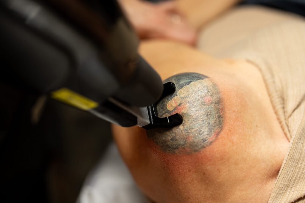 How tattoo removal works: the picosecond laser