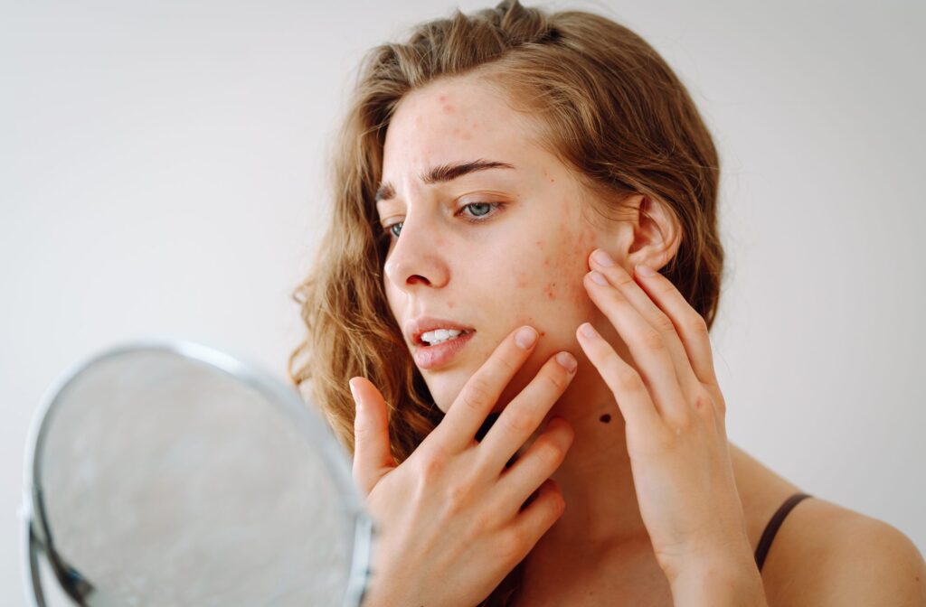 Stress doesn't cause pimples, but it can make acne worse: what scientific studies say