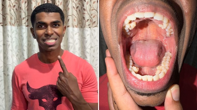 man-records-most-teeth-in-the-world