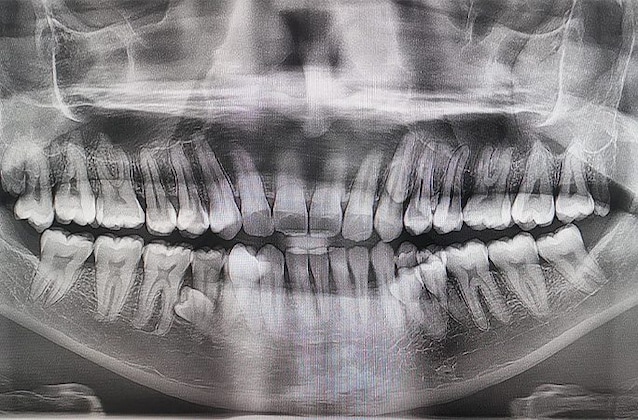 x-ray-man-record-teeth