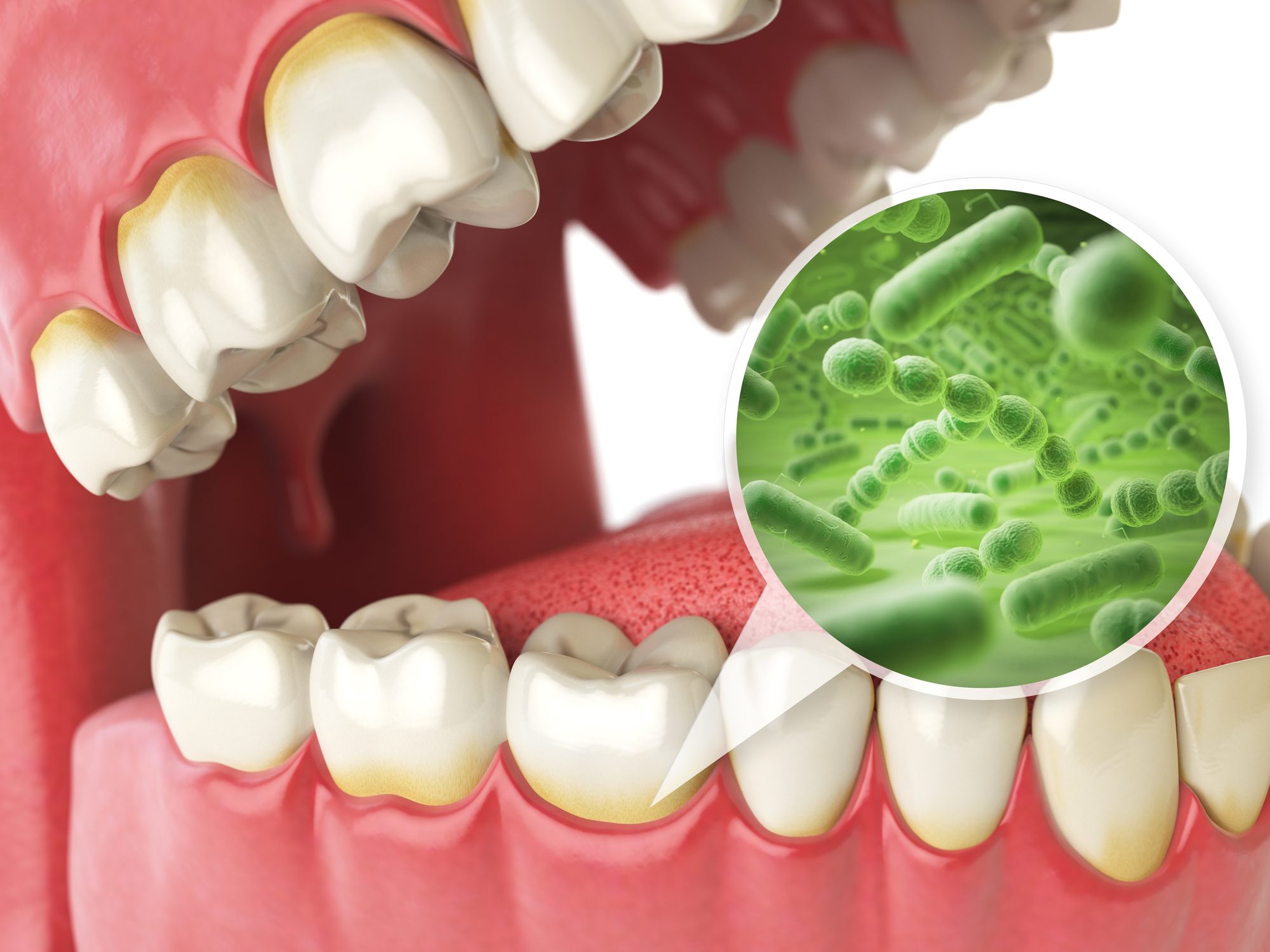 Tooth decay is caused by acids produced by bacteria in the mouth: WHO data