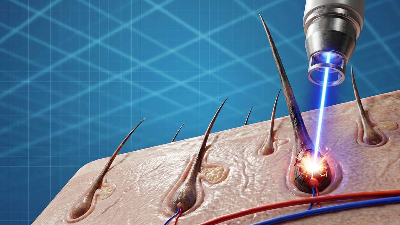 How laser hair removal works and how effective it is on hair: the principle of selective photothermolysis