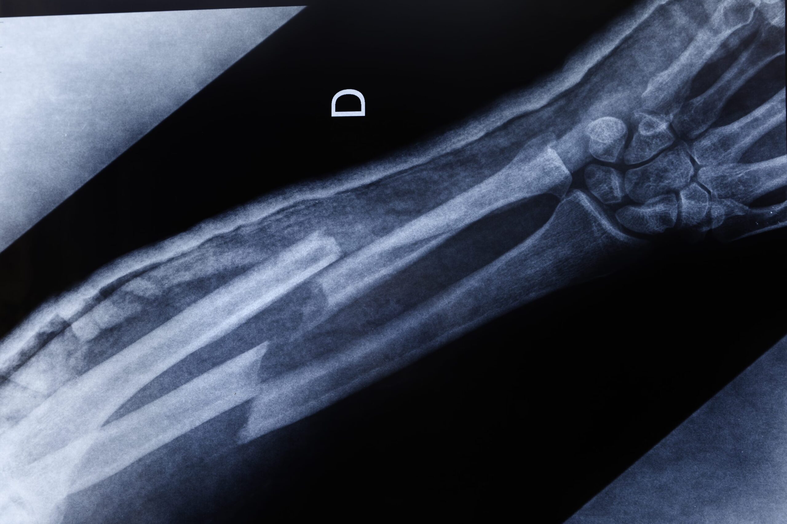 How the body regenerates broken bones after a fracture: the process from hematoma to remodeling